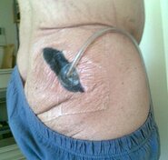 Glute+abscess+2.jpg