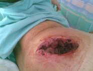 Glute+abscess.jpg