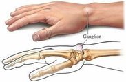 Ganglion-Cysts-300x195 (1).jpg