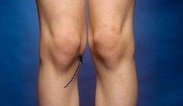 M350327-Knock-knees-SPL_342x198.jpg