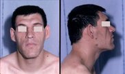 Acromegaly_facial_features.JPEG